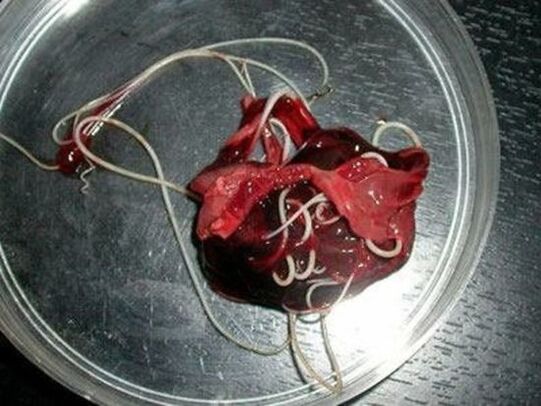 червеи от човешкото тяло